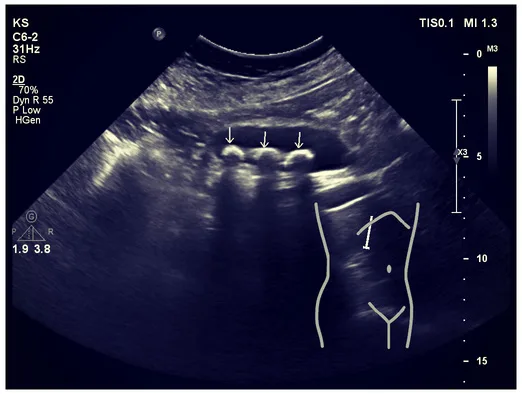 USG: kamica pęcherzyka żółciowego