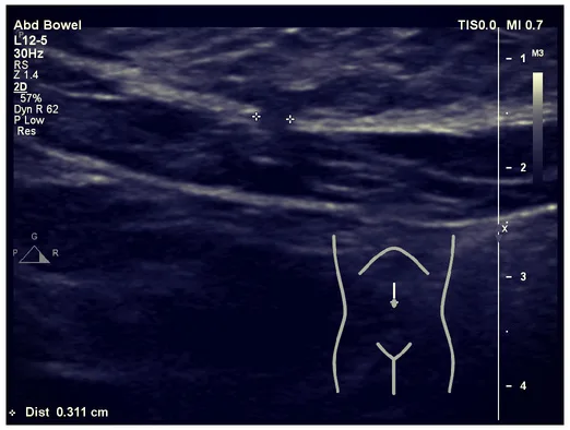 USG: przepuklina brzuszna