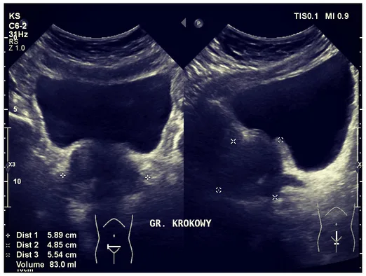 USG: przerost prostaty